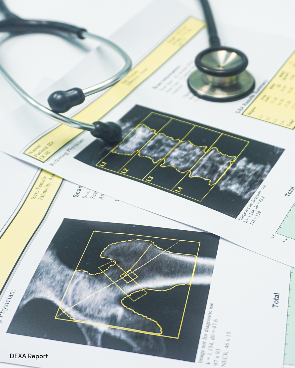 Bone Density Scans in Perimenopause and Menopause: Why They Matter More Thank You Think